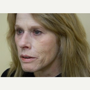 55-64 year old woman treated with Mini Lift, Browlift, 4-Lid Blepharoplasty and Fraxel before 3264694