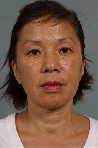 Juvederm LiquidLift after 224508
