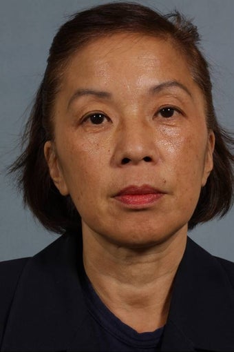 Juvederm LiquidLift before 224508