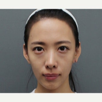 25-34 year old woman treated with Fat Transfer before 2046629