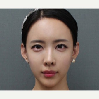 25-34 year old woman treated with Fat Transfer after 2046629