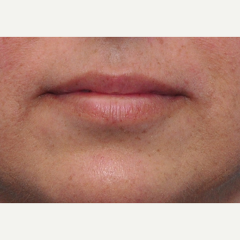 41 year old woman immediately after lip augmentation with Restylane before 3825536
