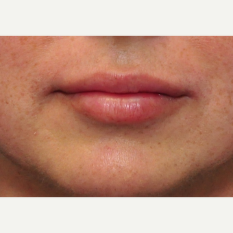 41 year old woman immediately after lip augmentation with Restylane after 3825536