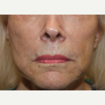 65-74 year old woman treated with Liquid Facelift after 3241087