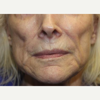 65-74 year old woman treated with Liquid Facelift before 3241087