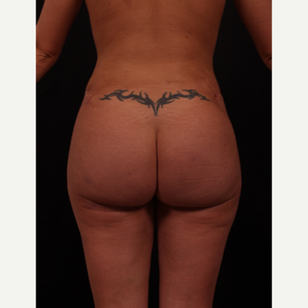 25-34 year old woman treated with Brazilian Butt Lift after 3649794