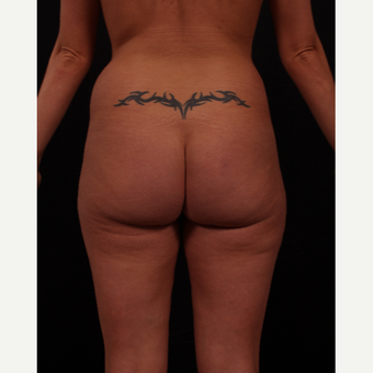 25-34 year old woman treated with Brazilian Butt Lift before 3649794