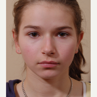 17 or under year old woman treated with Ear Surgery after 3725140