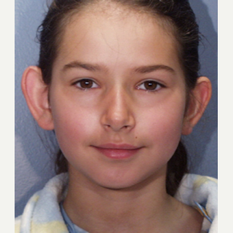 17 or under year old woman treated with Ear Surgery before 3725140