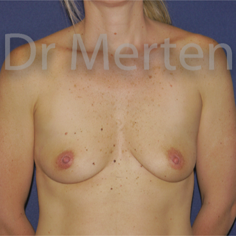 35-44 year old woman treated with Breast Augmentation before 3675962