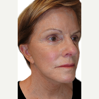 55-64 year old woman treated with Eyelid Surgery after 3548884