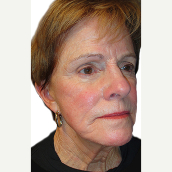55-64 year old woman treated with Eyelid Surgery before 3548884