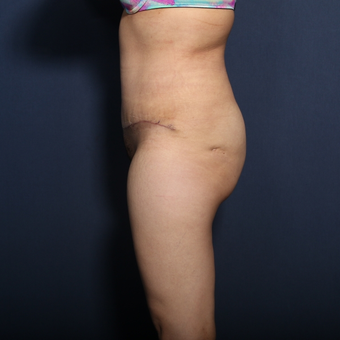 35-44 year old woman treated with Tummy Tuck (view 2 of 2) after 3129171