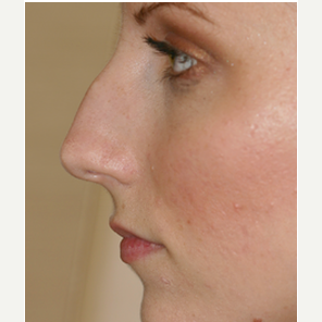 25-34 year old woman treated with Rhinoplasty before 3088990