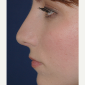 25-34 year old woman treated with Rhinoplasty after 3088990