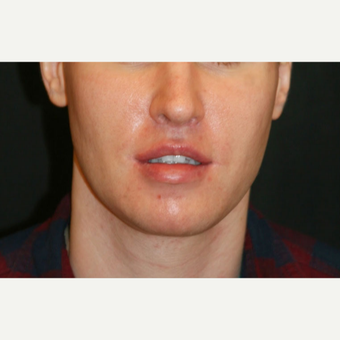 25-34 year old man treated with Jaw Reduction after 3648676