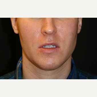 25-34 year old man treated with Jaw Reduction before 3648676