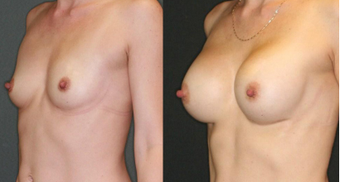 Mother, mid 30s, breast augmentation with 330cc anatomical implants after 1050497