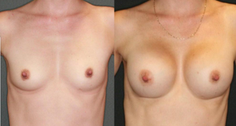 Mother, mid 30s, breast augmentation with 330cc anatomical implants before 1050497
