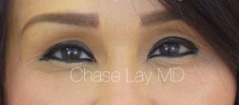 45-54 year old woman treated with Asian Rhinoplasty after 3305775