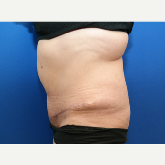 45-54 year old woman treated with Tummy Tuck, Scar Revision, and Hernia Repair after 3104913