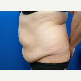 45-54 year old woman treated with Tummy Tuck, Scar Revision, and Hernia Repair before 3104913