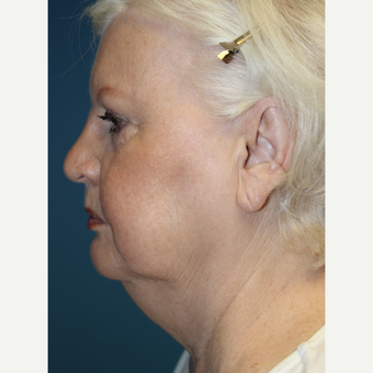 65-74 year old woman treated with Facelift before 3701999