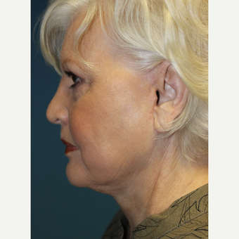 65-74 year old woman treated with Facelift after 3701999
