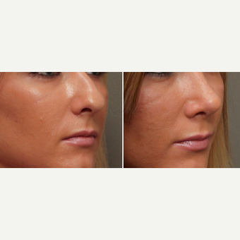18-24 year old woman treated with Rhinoplasty before 3033614