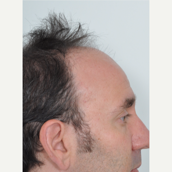50 year old man treated with Hair Transplant before 3055180