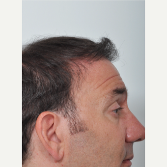50 year old man treated with Hair Transplant after 3055180
