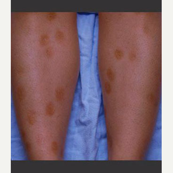 18-24 year old woman treated with IPL before 3710911