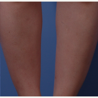 18-24 year old woman treated with IPL after 3710911