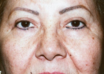 Upper Blepharoplasty after 1003290