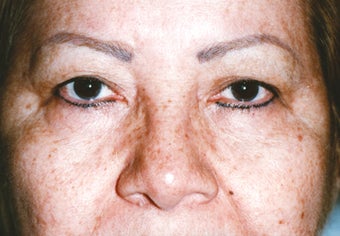 Upper Blepharoplasty before 1003290
