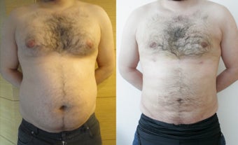 35-44 year old woman treated with Vaser Liposuction before 2522083