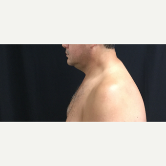 45-54 year old man chin treated with CoolSculpting before 3594841