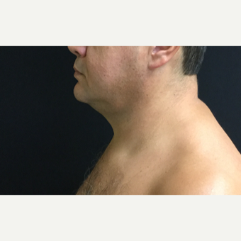 45-54 year old man chin treated with CoolSculpting after 3594841