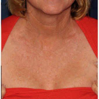 65 year old woman treated with IPL after 2769967