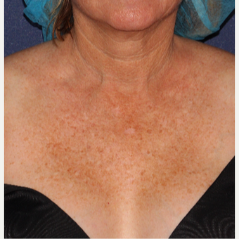 65 year old woman treated with IPL before 2769967