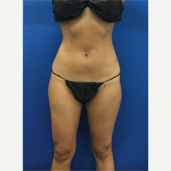 25-34 year old woman treated with Laser Liposuction after 3142293