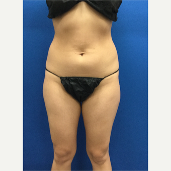 25-34 year old woman treated with Laser Liposuction before 3142293