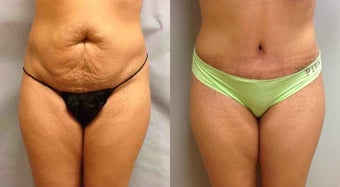 Abdominoplasty (Tummy Tuck) before 304447