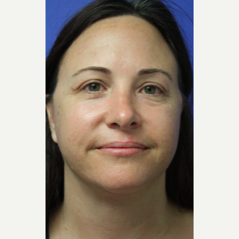 35-44 year old woman treated with Facelift after 3405572