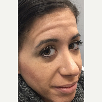 25-34 year old woman treated with Botox before 3837015