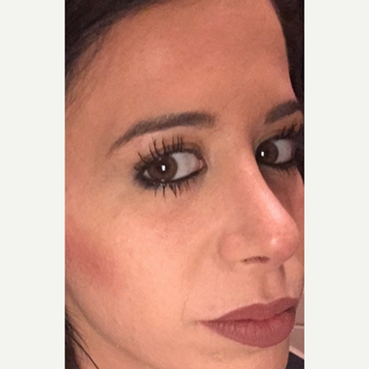 25-34 year old woman treated with Botox after 3837015