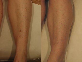 Sun Damage Removal Legs Before and After Photos before 1350758
