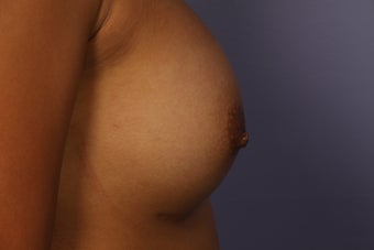 Inverted Nipple Repair after 692986
