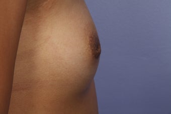Inverted Nipple Repair before 692986
