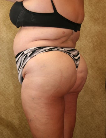 Brazilian Butt lift for plus size woman after 993828